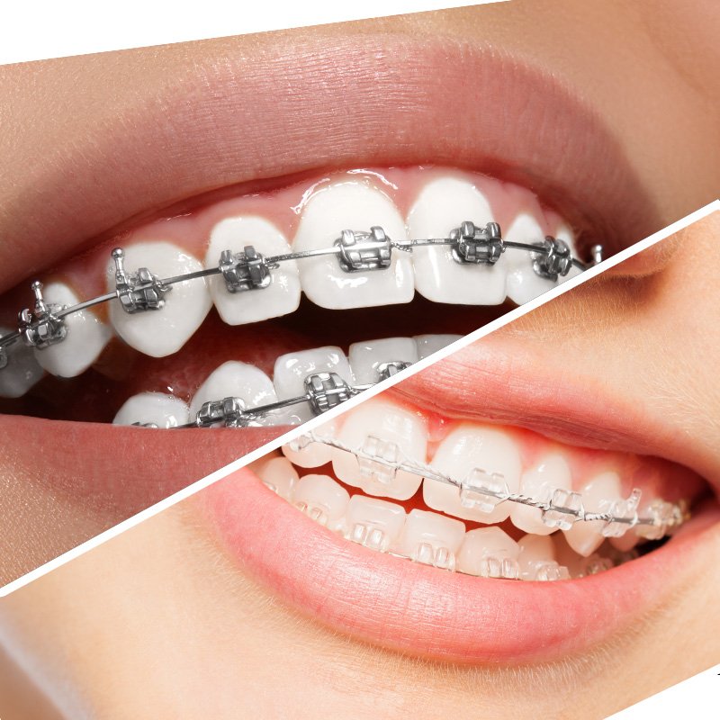 Braces for All Ages