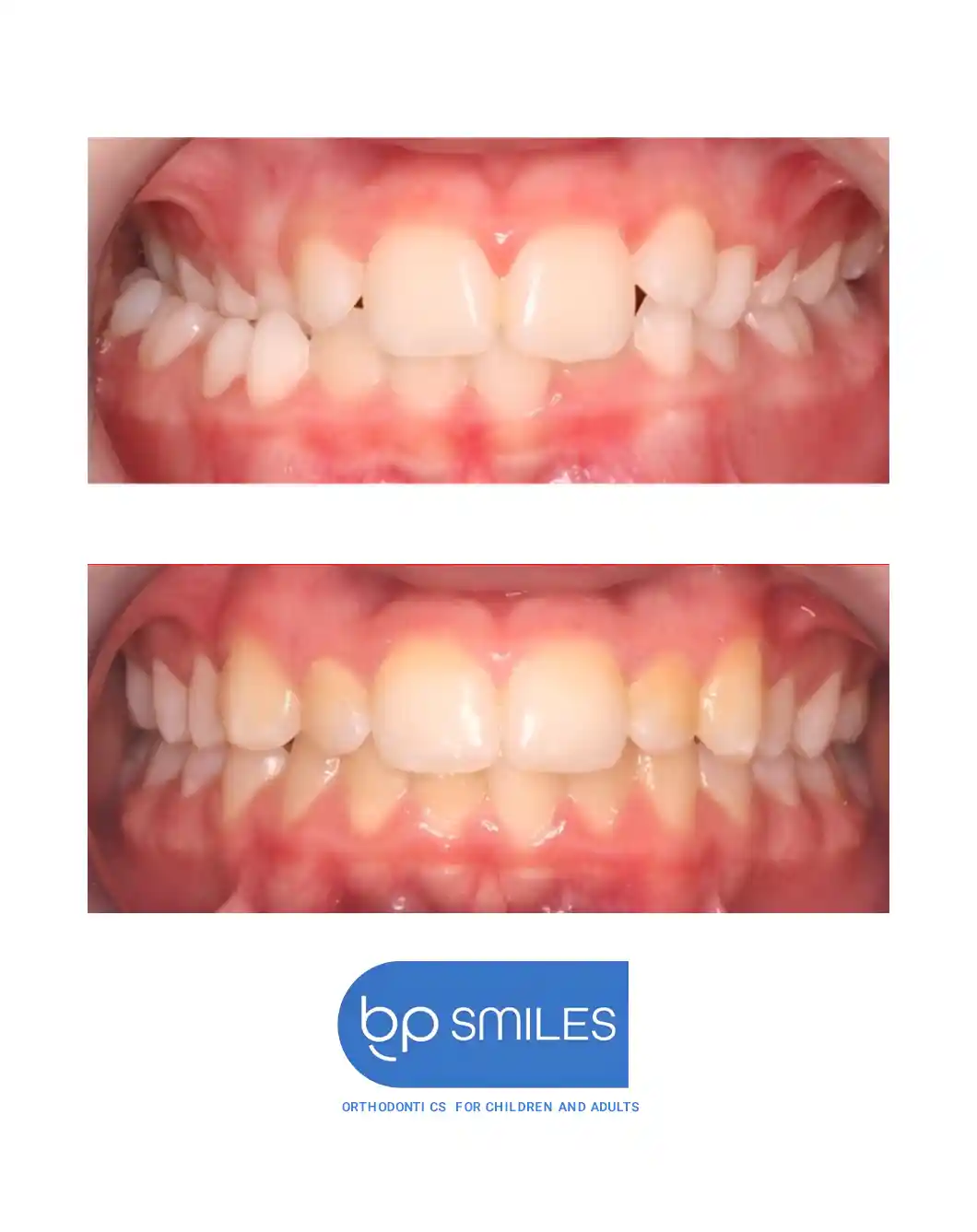 Before and after orthodontic treatment